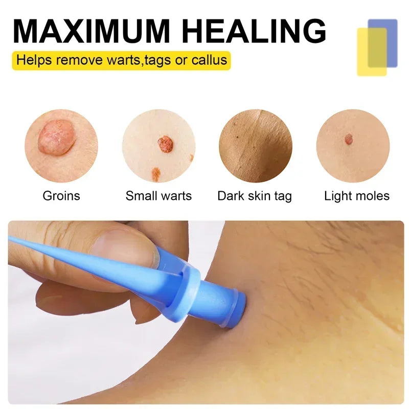 DermaClear™ Skin Tag Removal Kit