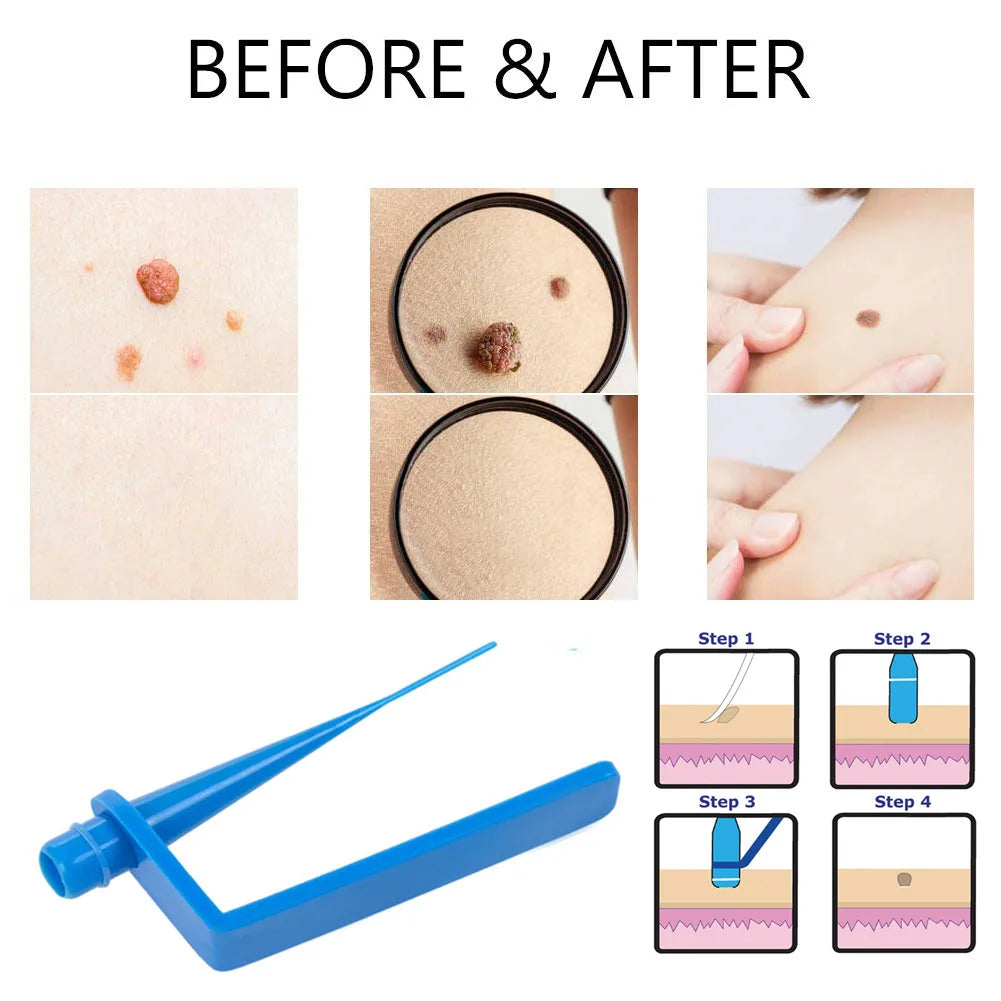 DermaClear™ Skin Tag Removal Kit