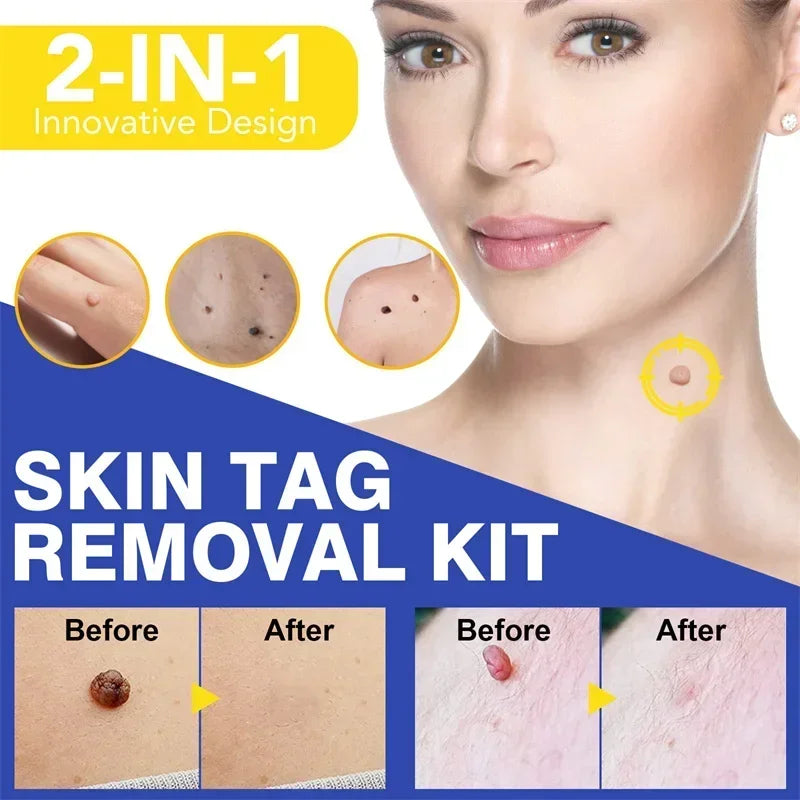 DermaClear™ Skin Tag Removal Kit