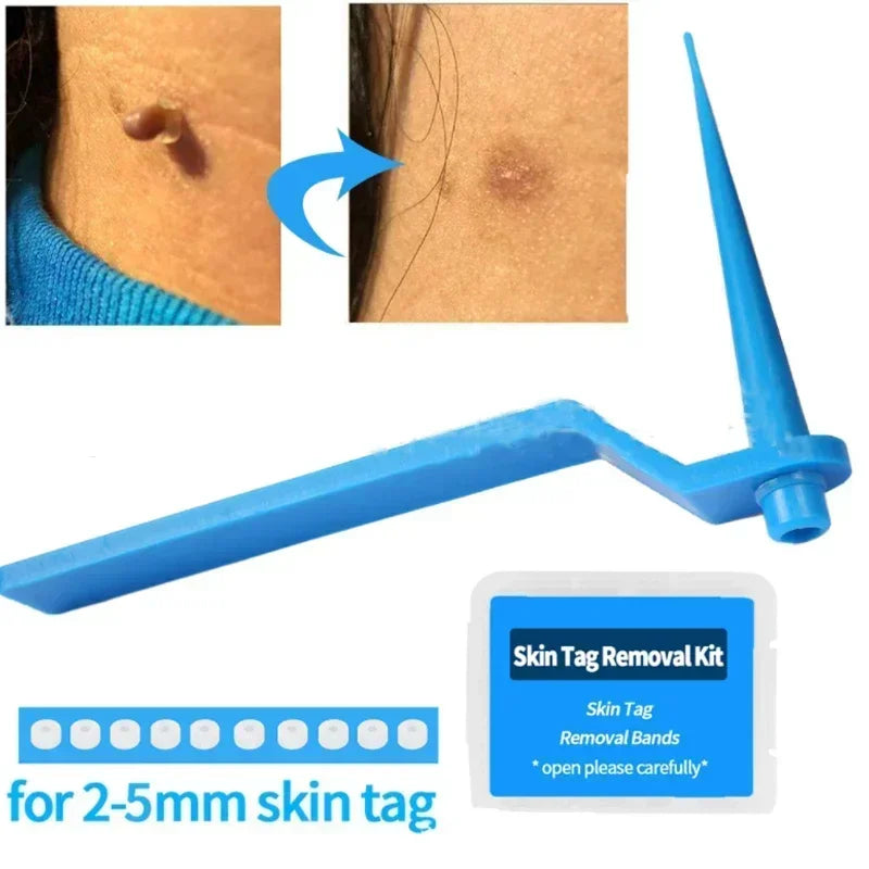 DermaClear™ Skin Tag Removal Kit