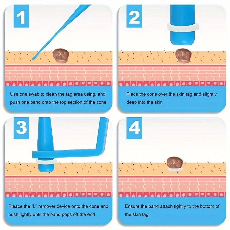 DermaClear™ Skin Tag Removal Kit
